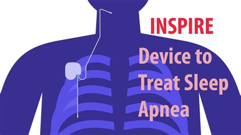 It’s a small device placed during a same-day, outpatient procedure. . Does tricare cover inspire for sleep apnea